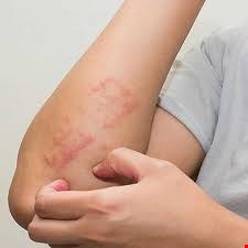 پک خارش و حساسیت پوست