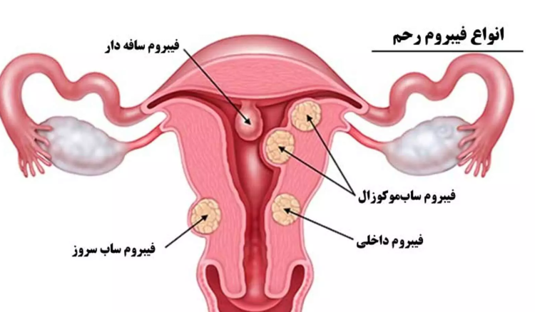  فیبروم رحم  زنان و طب سنتی